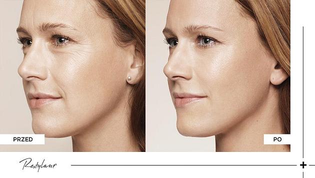 nici liftingujące skinlift 2